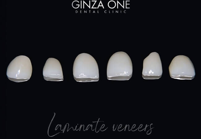 🦷 Natural and Undetectable Beauty — The Aesthetics of Laminate Veneers