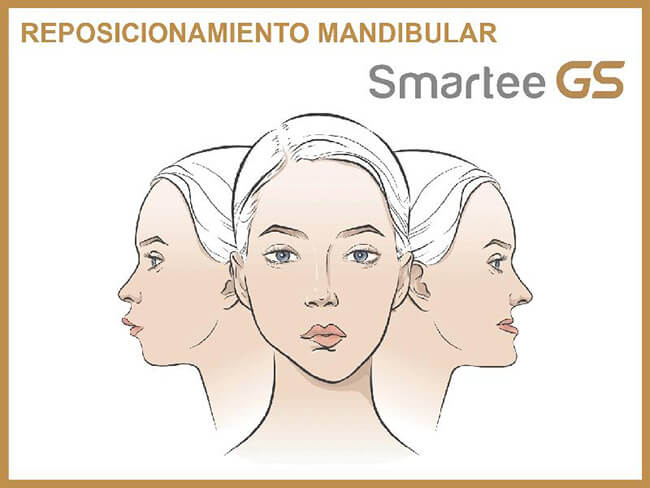 SmarteeGS