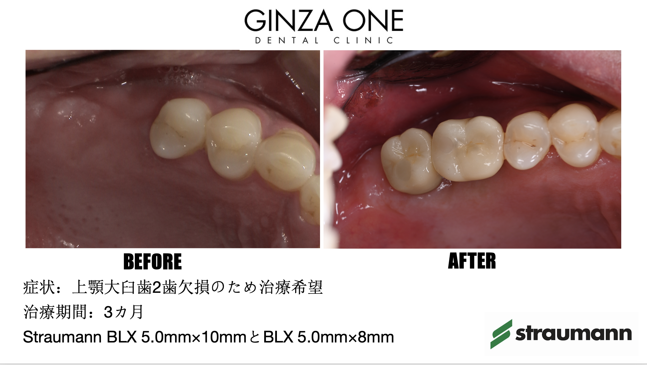 🦷インプラント治療の流れ｜初診からアフターケアまでをわかりやすく解説！