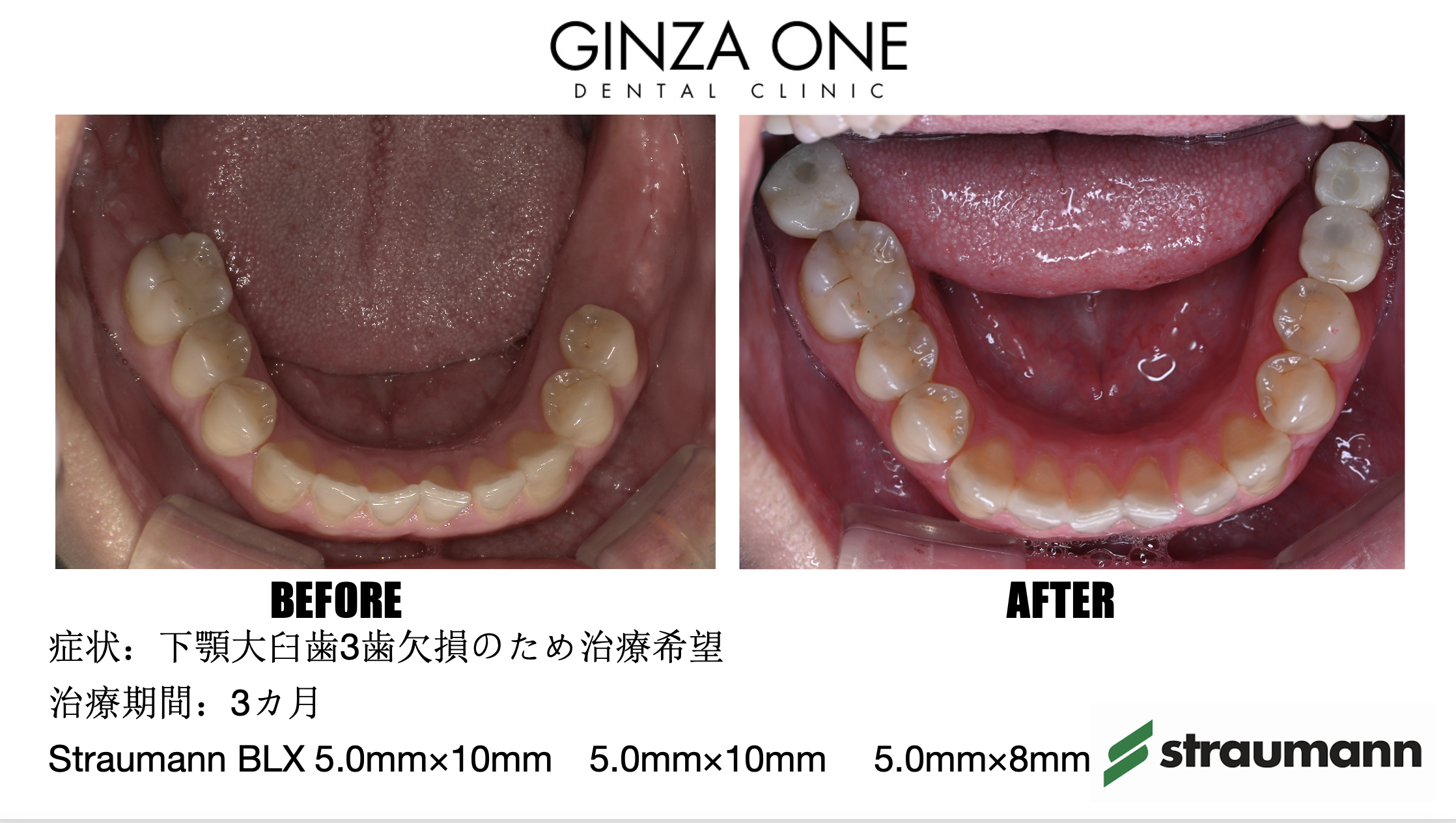 🦷 Can You Get a Dental Implant on the Same Day as a Tooth Extraction?