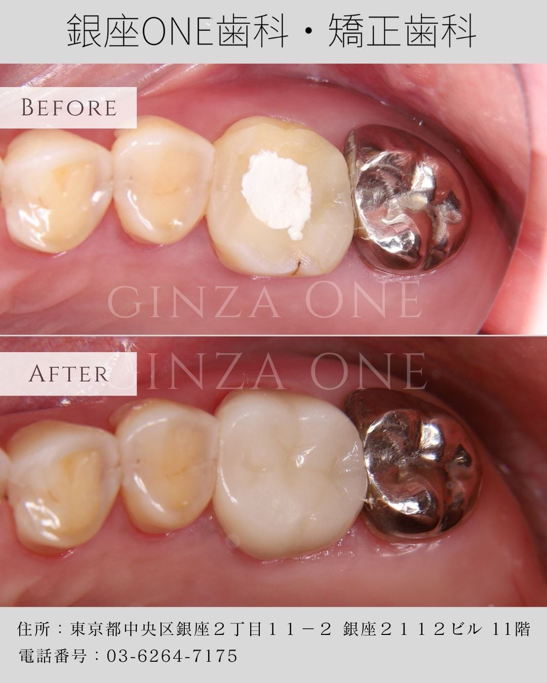 Zirconia Crowns – Where Aesthetics Meet Strength