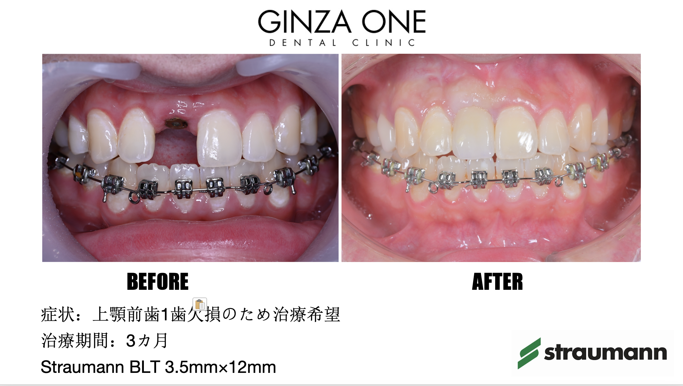 🦷Dental Implant Procedure: From First Visit to Long-Term Care