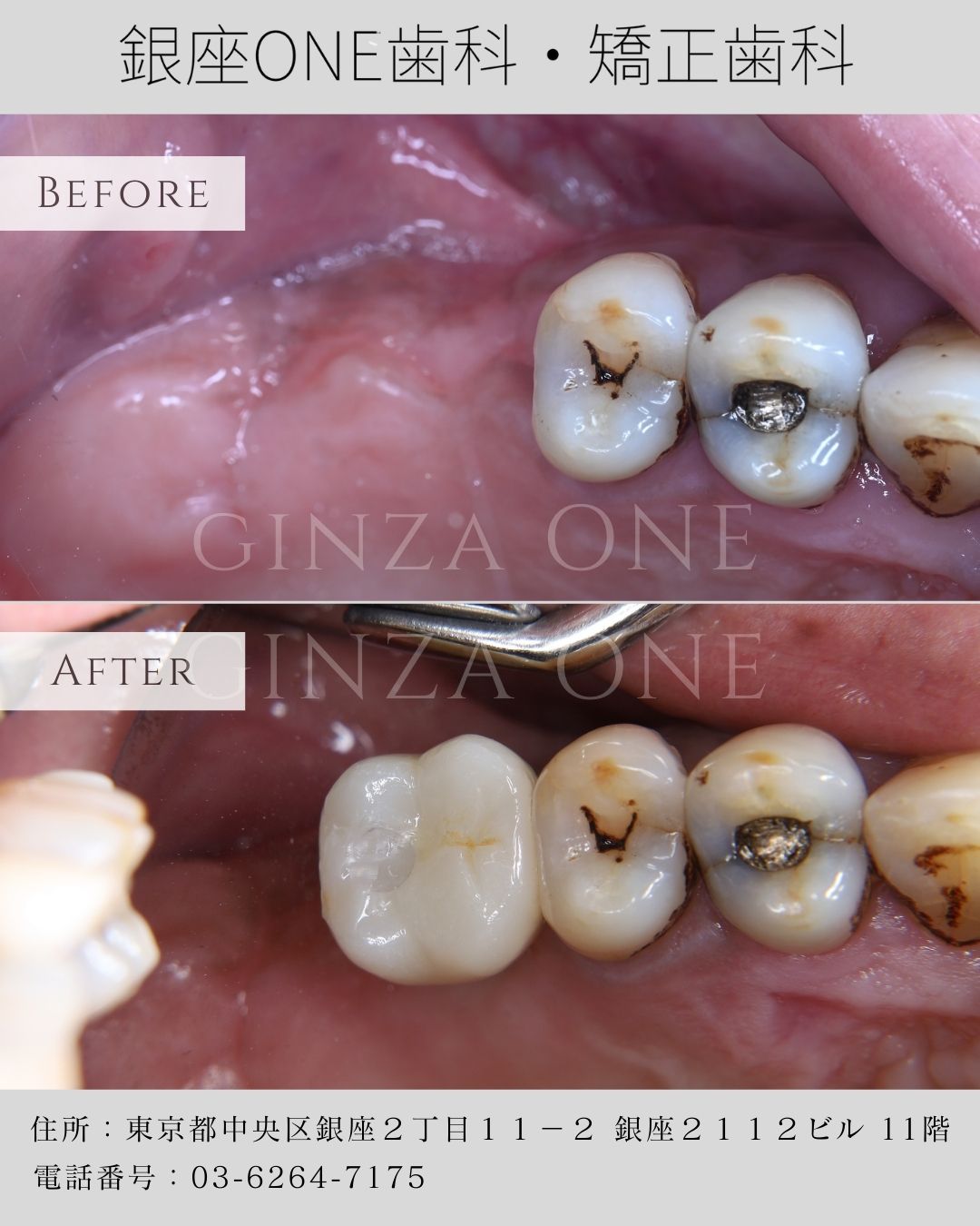 🦷 What Happens If You Leave a Missing Tooth Untreated? – The Importance of Dental Implants