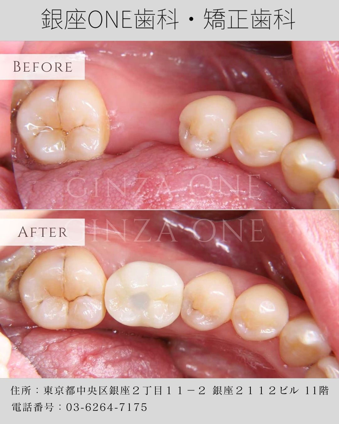 🦷 若々しい口元を保つ秘訣——骨吸収を防ぐインプラント治療