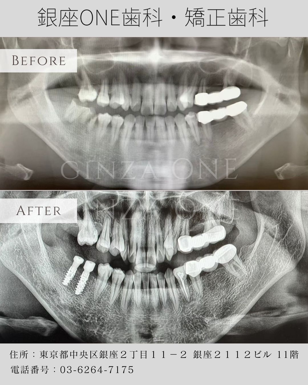 🦷 The Secret to Maintaining a Youthful Smile — Implant Treatment that Prevents Bone Loss