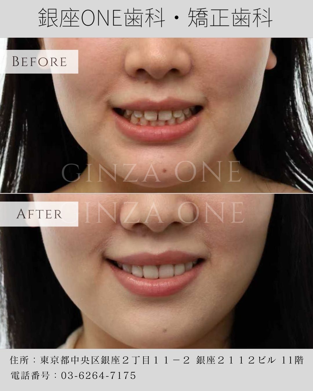 🦷 First Impressions Begin with a Smile — How the Aesthetics of Your Front Teeth Can Change Your Life