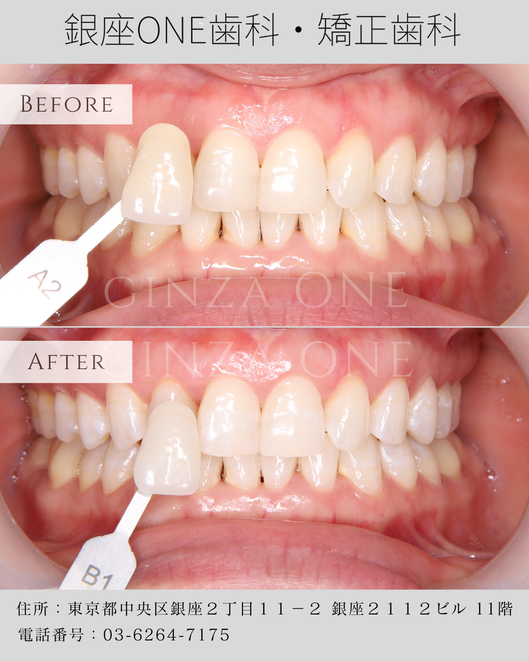 🦷 What Is Office Whitening?