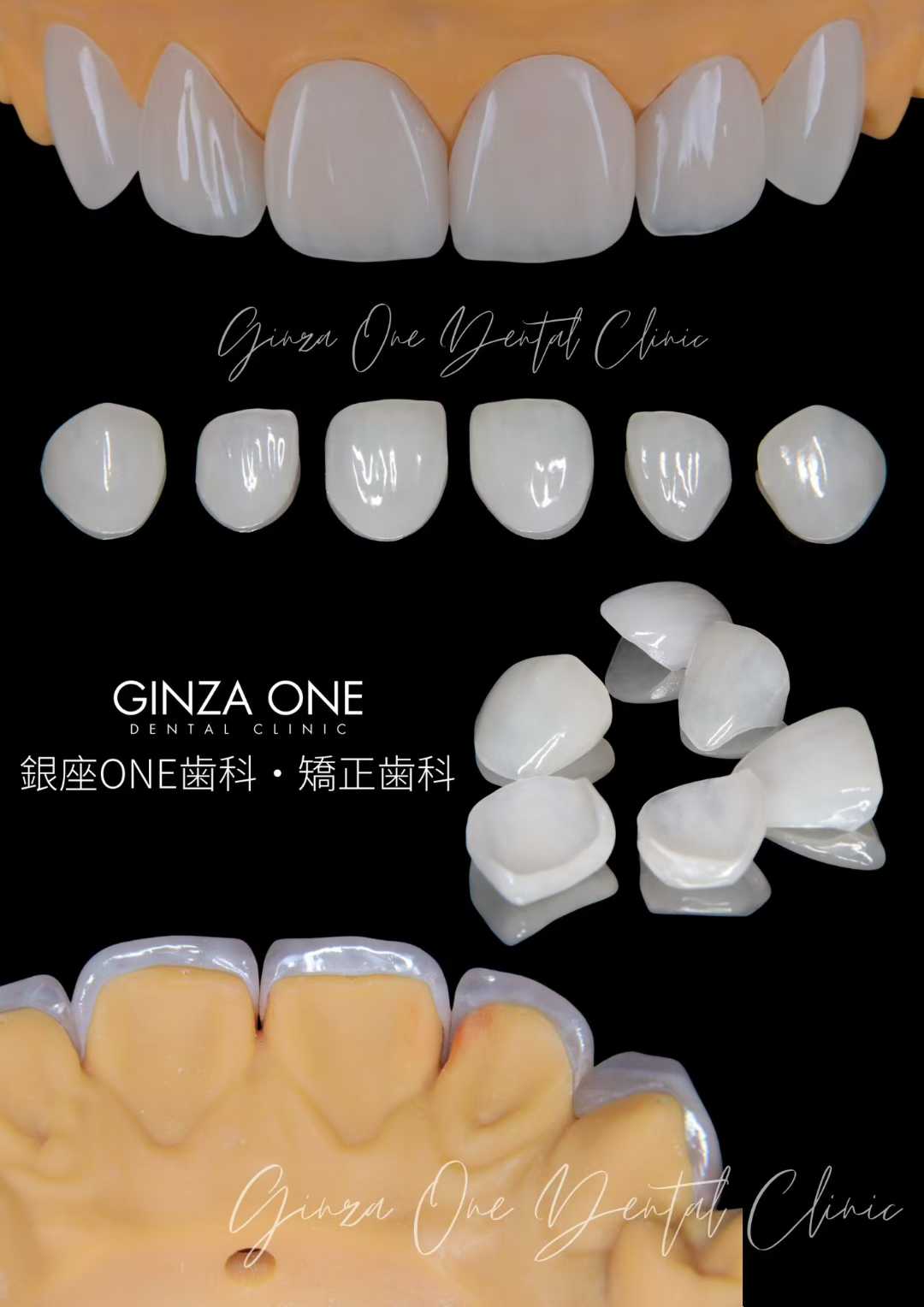 🦷 自然でバレない美しさ——ラミネートベニアの審美性
