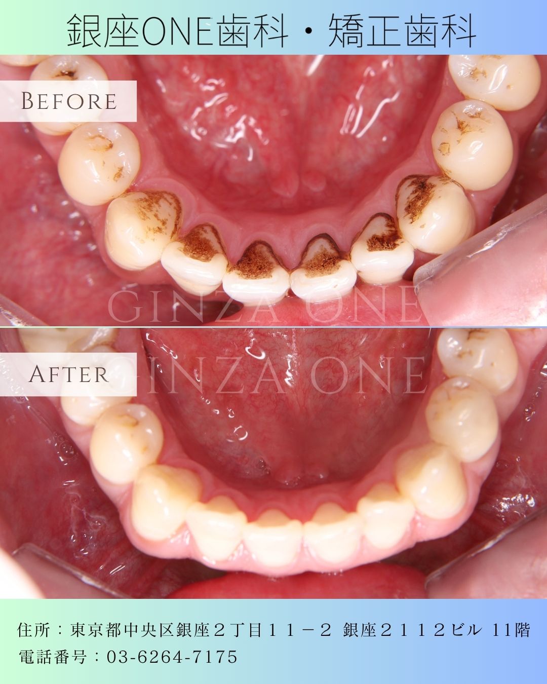 ✨ Airflow Dental Cleaning: Why Do We Recommend Annual Care?