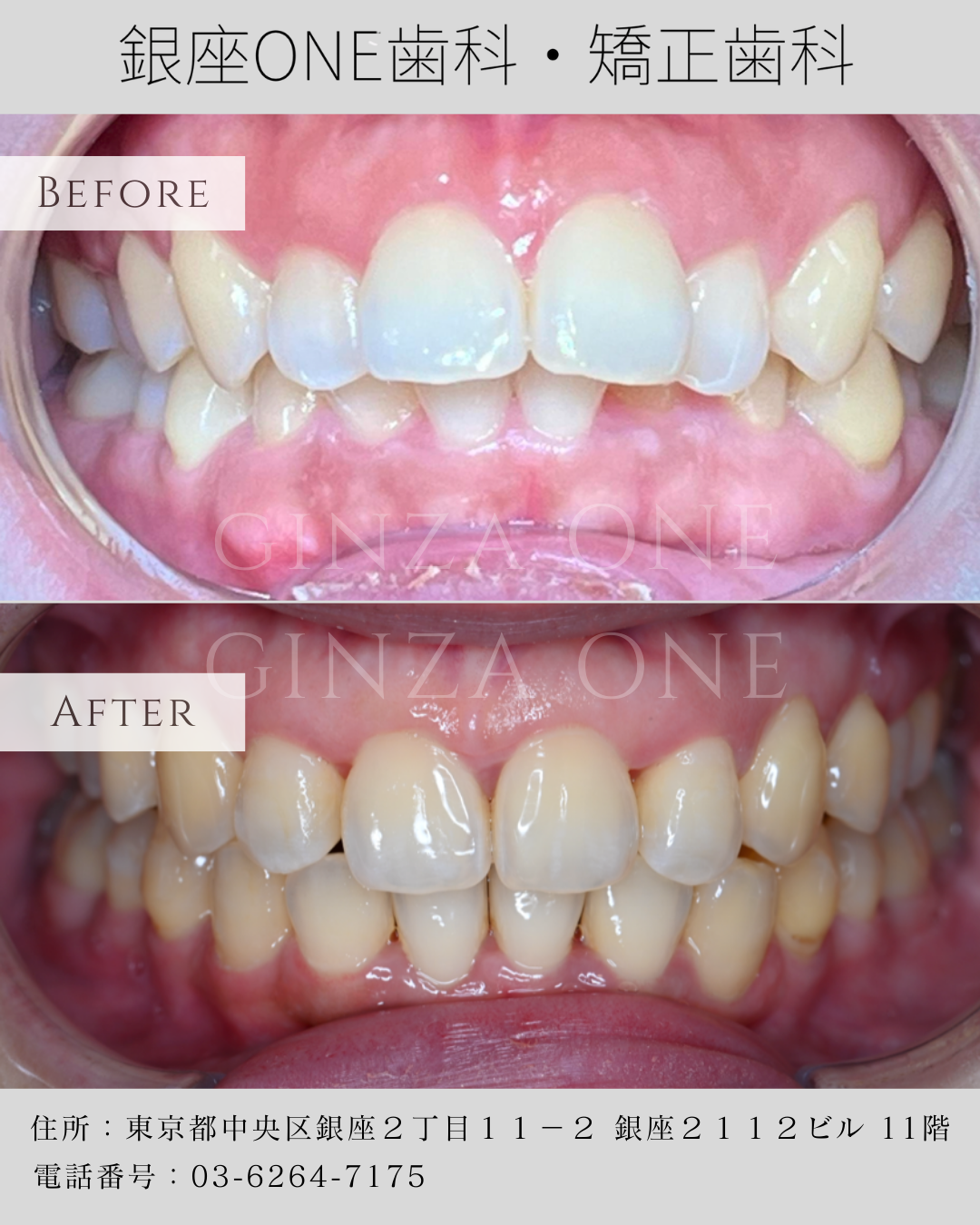 🦷✨ The Advantages of Clear Aligners — A Modern Approach to a Natural Smile