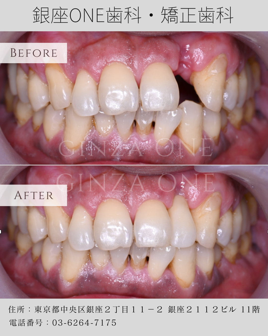 🦷 インプラントに抵抗がある方必見！接着ブリッジで自然な噛み心地を