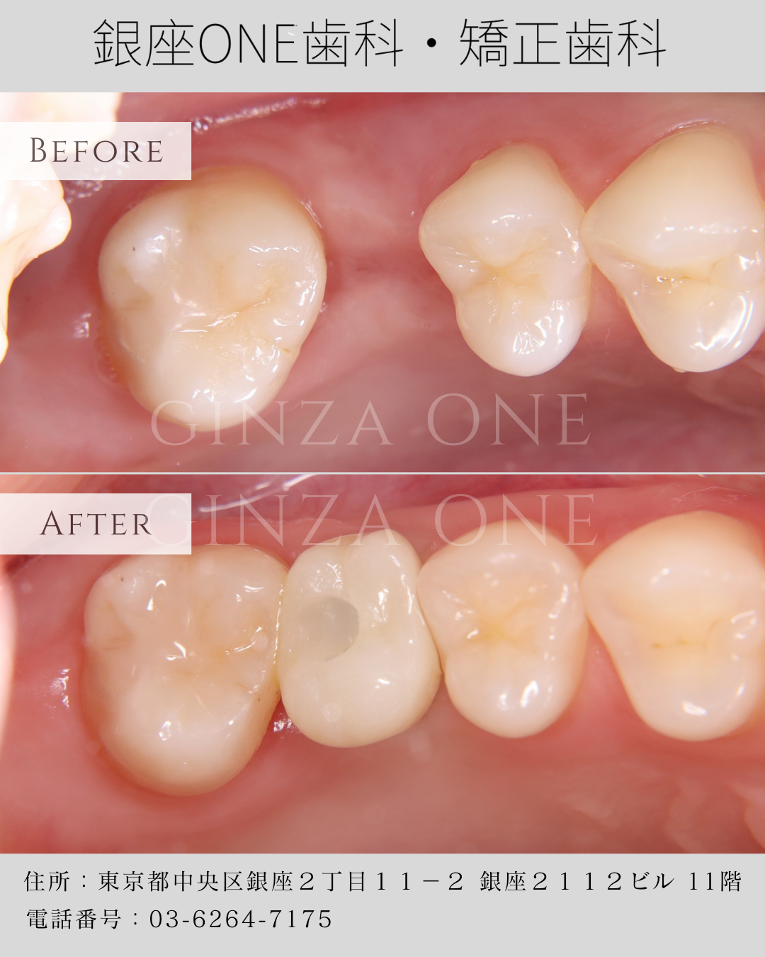 Missing Teeth? The Hidden Risks of Leaving Gaps—and How to Restore Your Smile