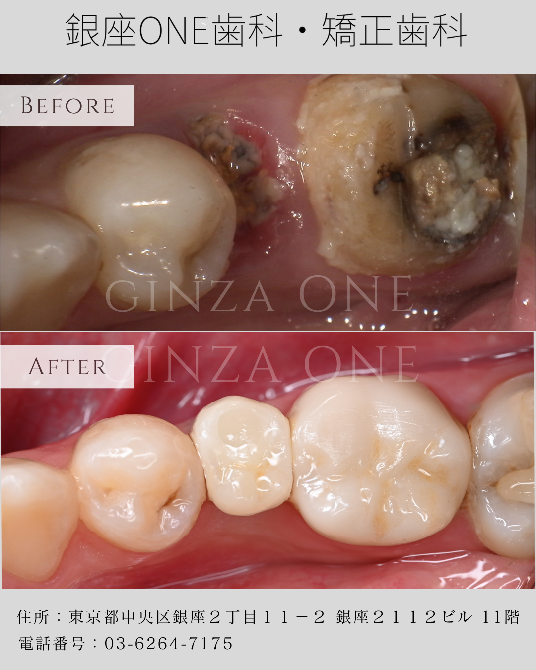 自分の歯を残したい——その気持ちはよく分かります。でも、抜かざるを得ないこともあります
