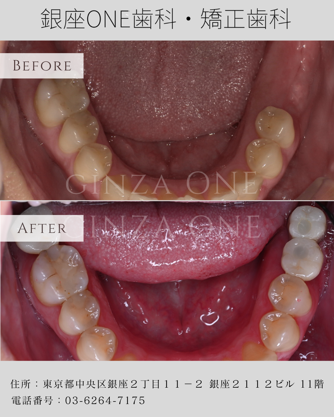 💬 想保留原牙的心情，我们理解——但有时候，不拔不行