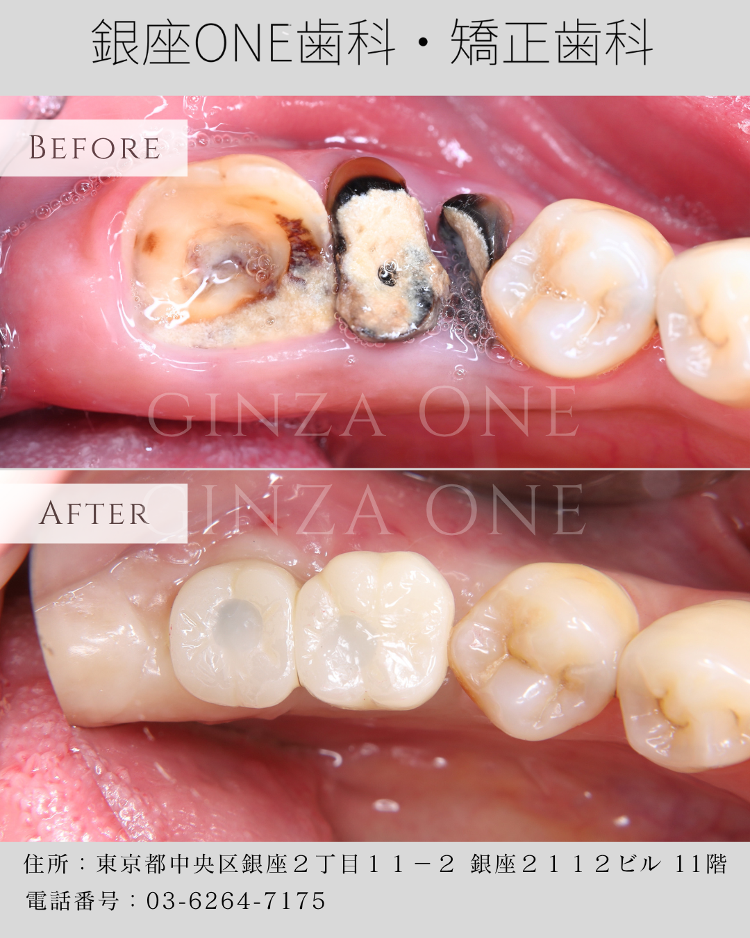 💬 We Understand Wanting to Keep Your Own Tooth — But Sometimes, Extraction Is the Right Choice