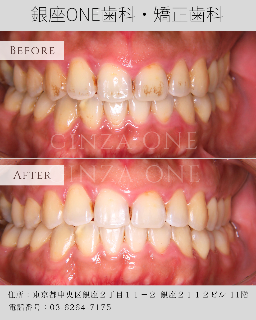 ✨エアフロー vs 従来のスケーリング