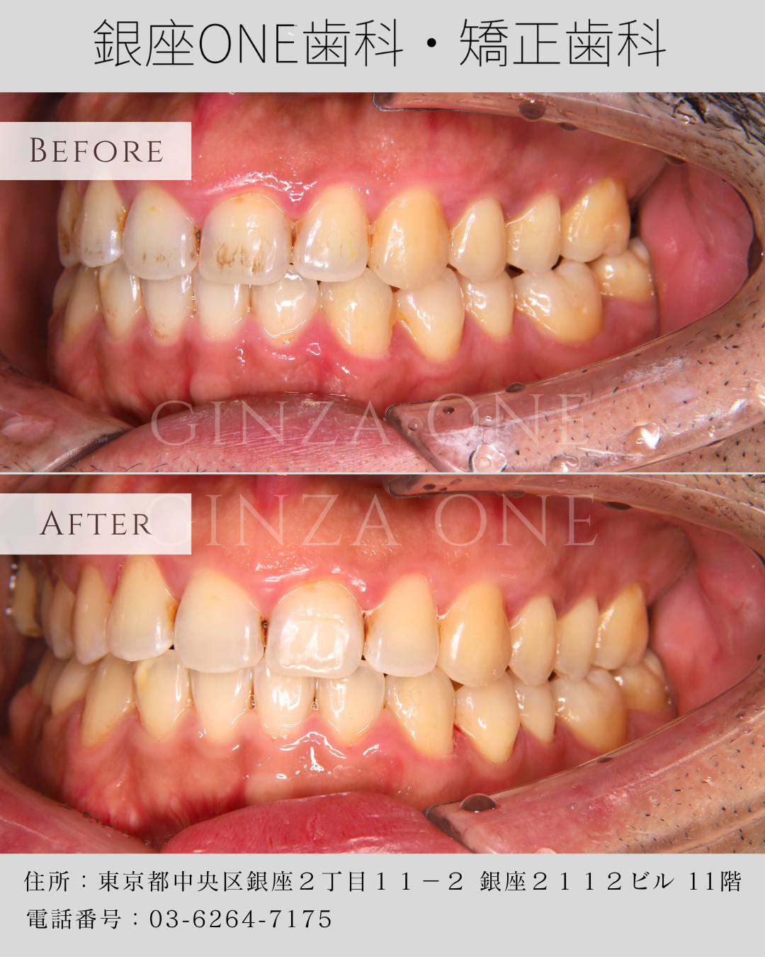 🌿 Airflow Cleaning vs Traditional Scaling — What’s the Difference?✨