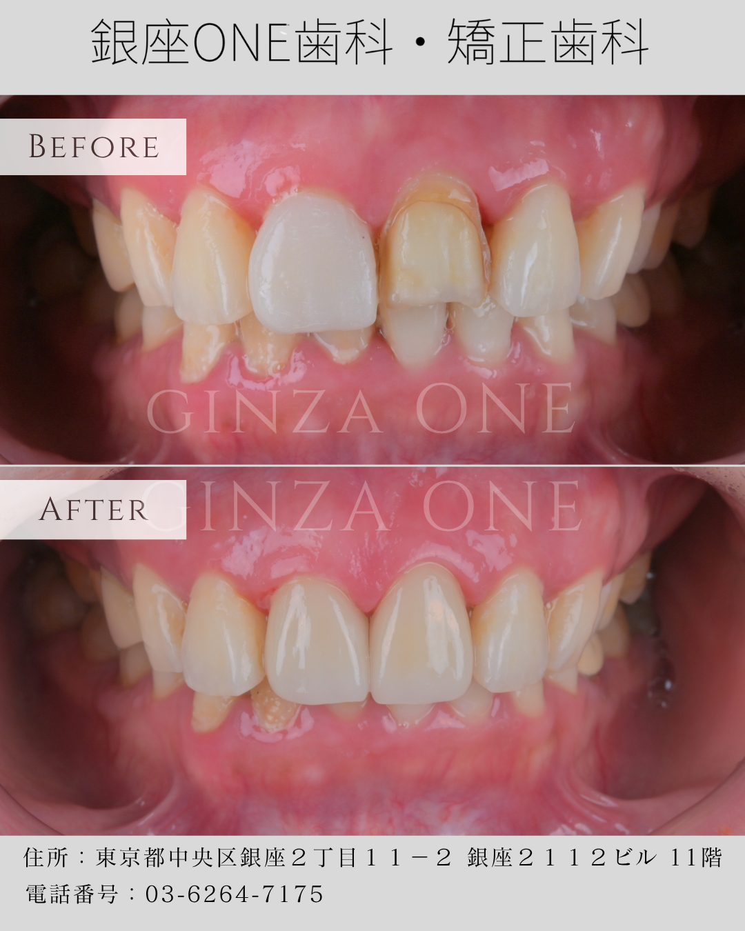 How Long Do Veneers Last? Complete Guide to Veneer Longevity, Care, Risks & Myths｜Ginza ONE Dental & Orthodontics