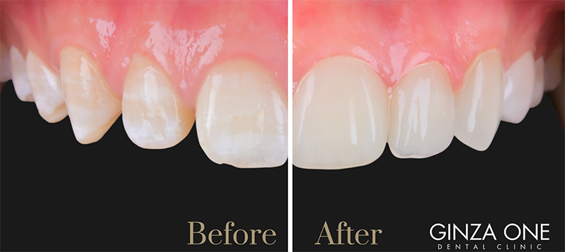 ラミネートべニア