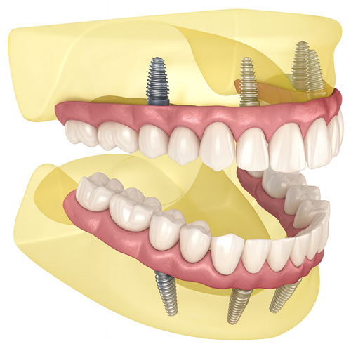 骨造成不要の低侵襲設計
