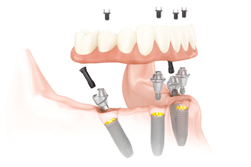 手術当日に固定式の仮歯を装着できます