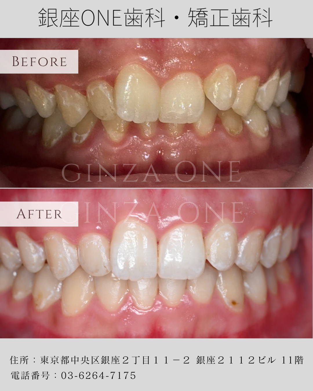 🍽️ Smartee 隐形矫正期间饮食指南