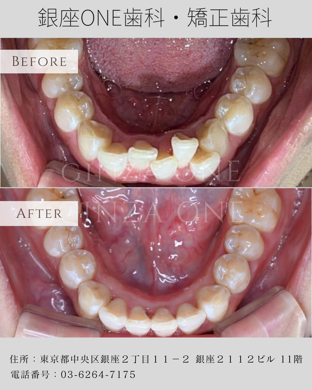 🍽️ Eating Smart During Your Smartee Clear Aligner Journey