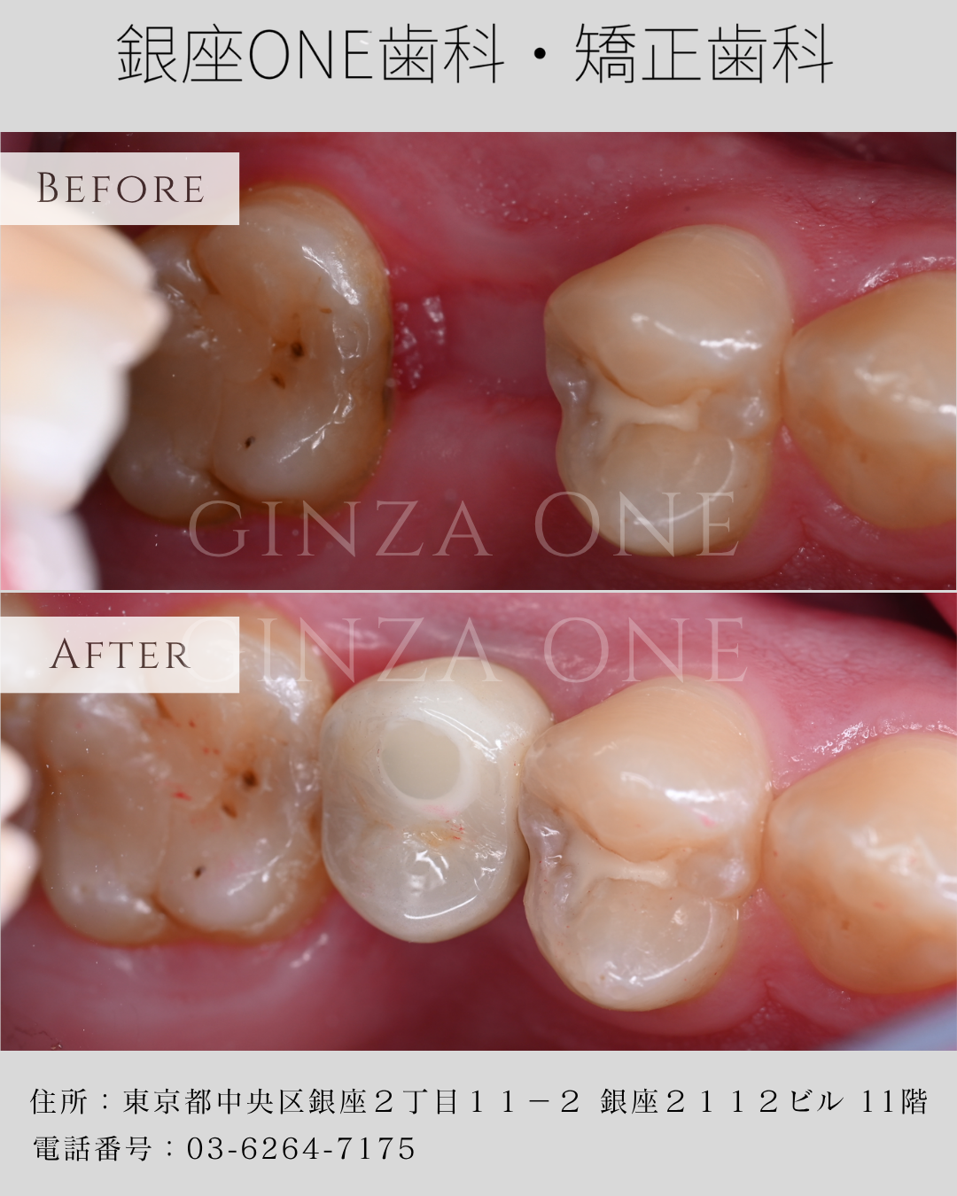 デジタル無切開インプラントで、より精密・より快適な治療を