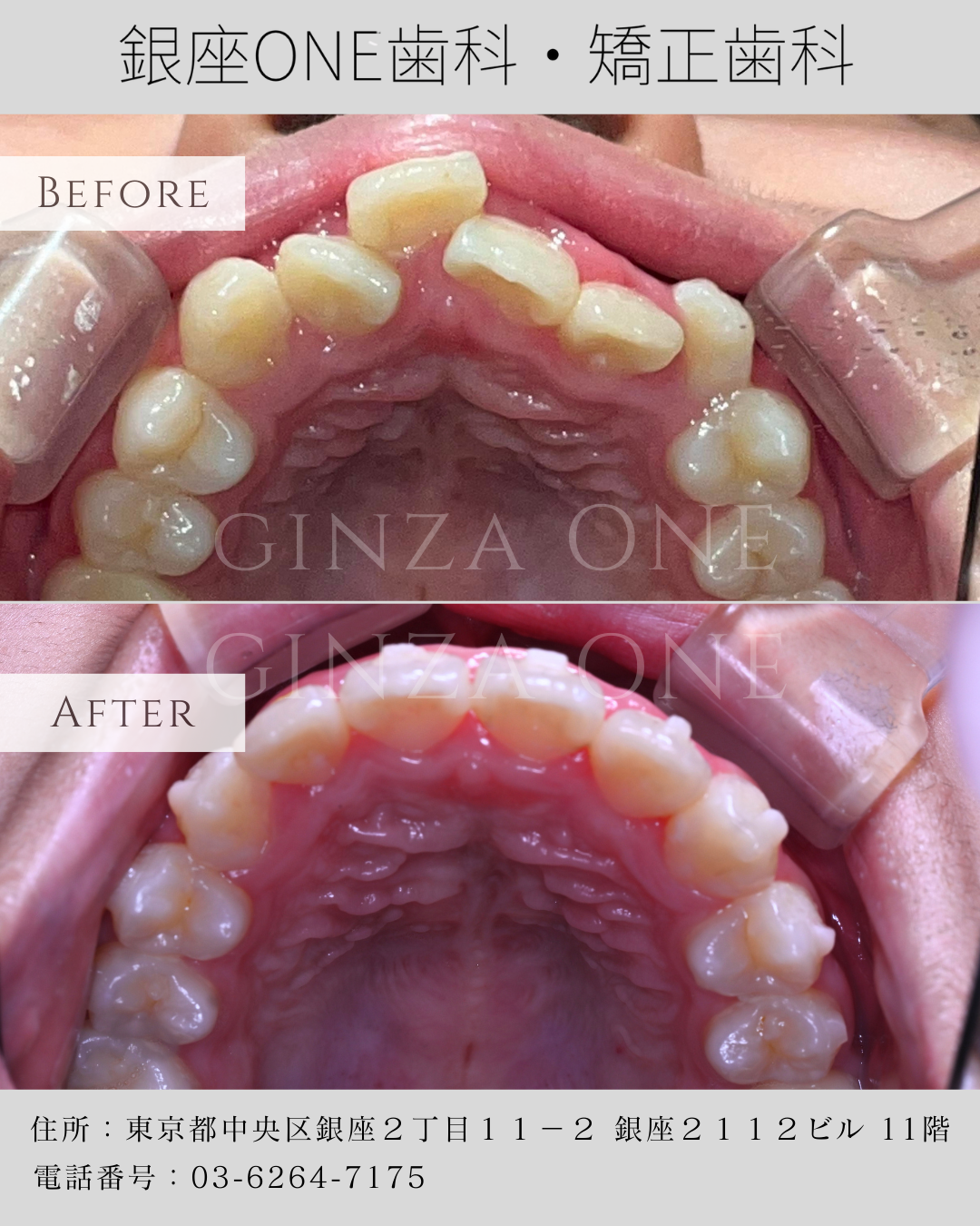 5 Essential Examinations Before Orthodontic Treatment｜Why the First Consultation Matters