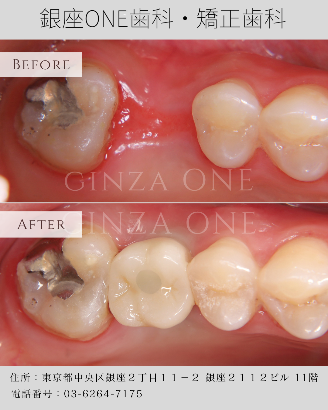 ✅ 数字化无翻瓣种植牙，让植牙更精准、更舒适