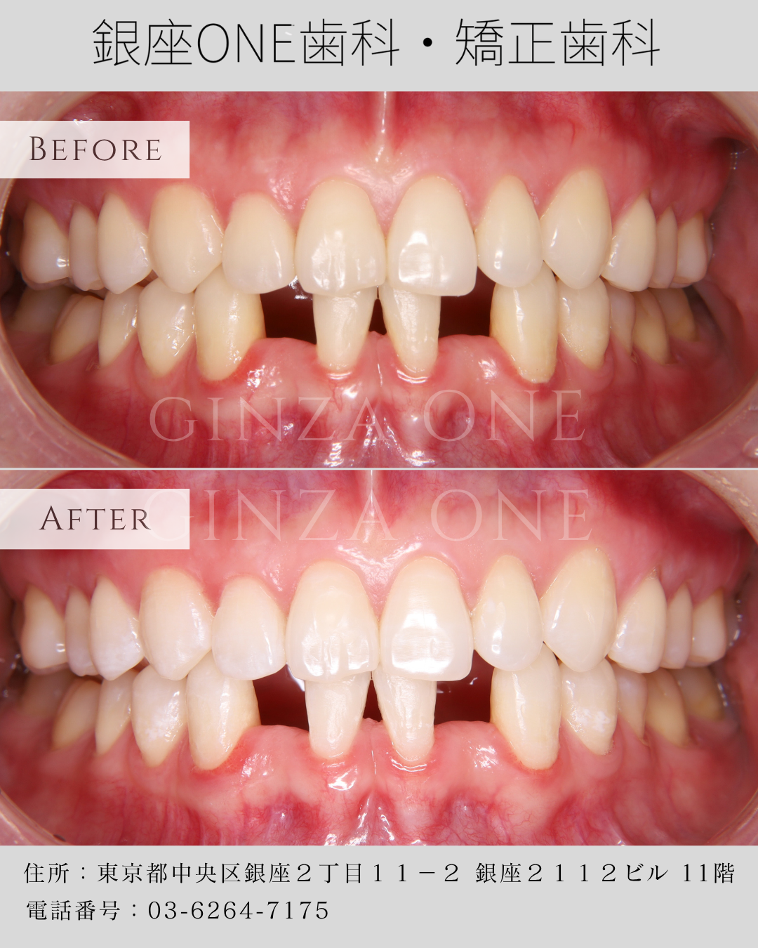 🦷✨ 年末前の駆け込みホワイトニング特集 ✨