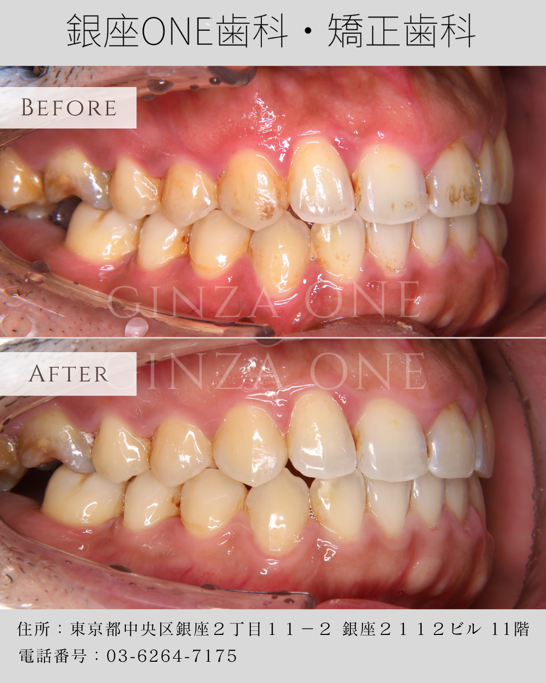✨喷砂洁牙 vs 传统洁牙：到底有什么不同？🦷