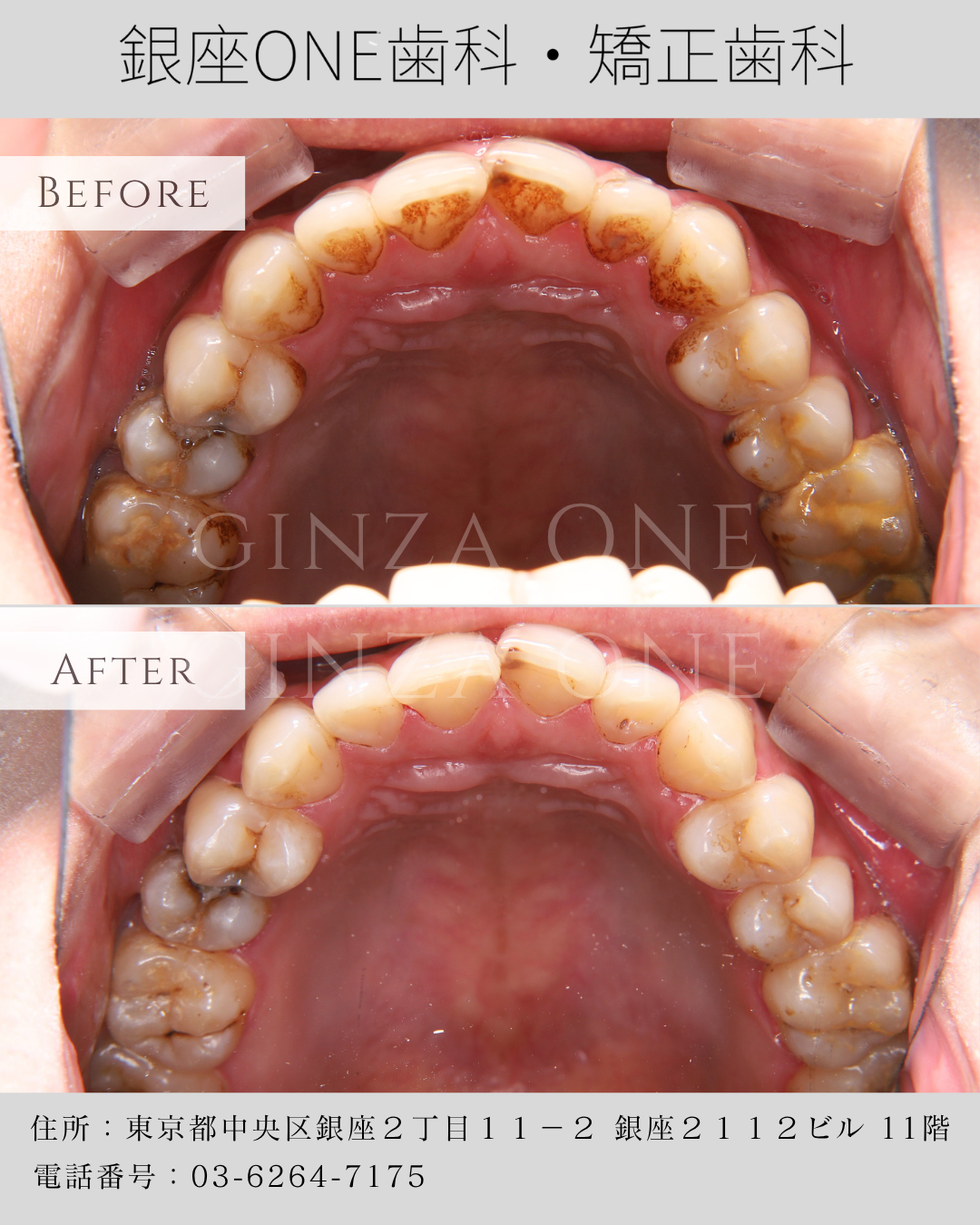 **📌 年末の大掃除はお口から!エアフローで一年分の着色を徹底リセット**