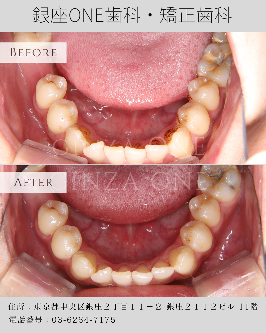 Start Your Year-End Cleaning with Your Smile! Reset a Year of Stains with AirFlow Cleaning.