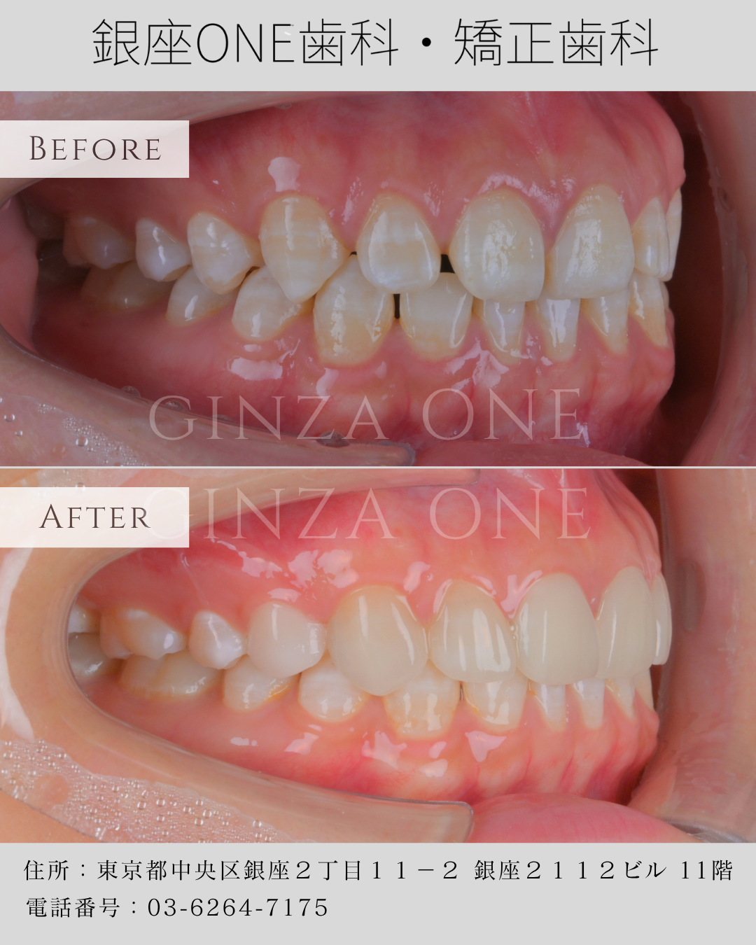 セラミックべニアはどれくらい持つ？寿命・ケア・誤解のすべて｜銀座ONE歯科・矯正歯科