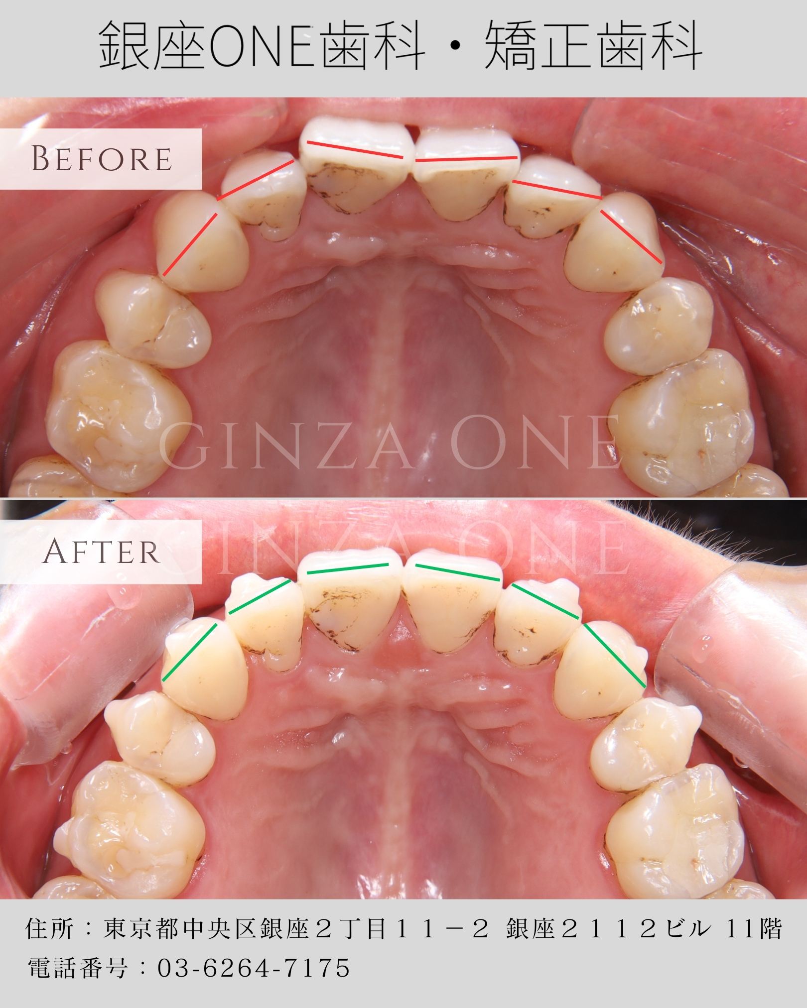 🍽️ マウスピース矯正中の食事OKリスト｜Smartee（スマーティ）矯正で“食べながらきれいに”