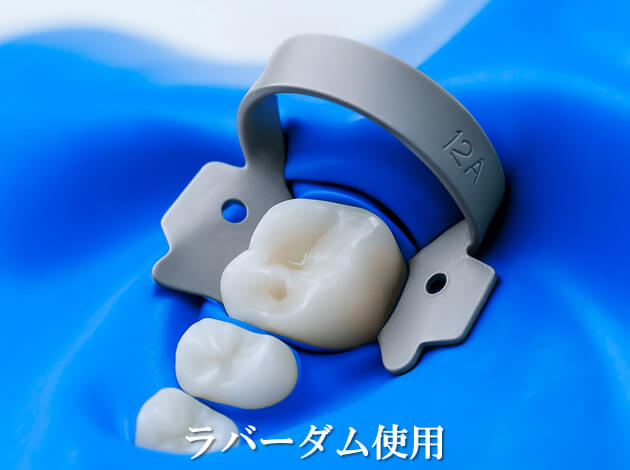 ラバーダム使用