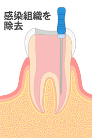 感染組織を除去