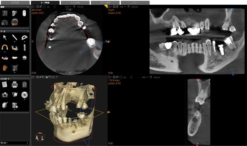 歯科用CTによる正確な診断