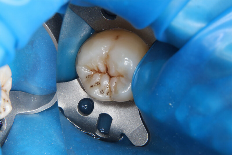 ラバーダム防湿