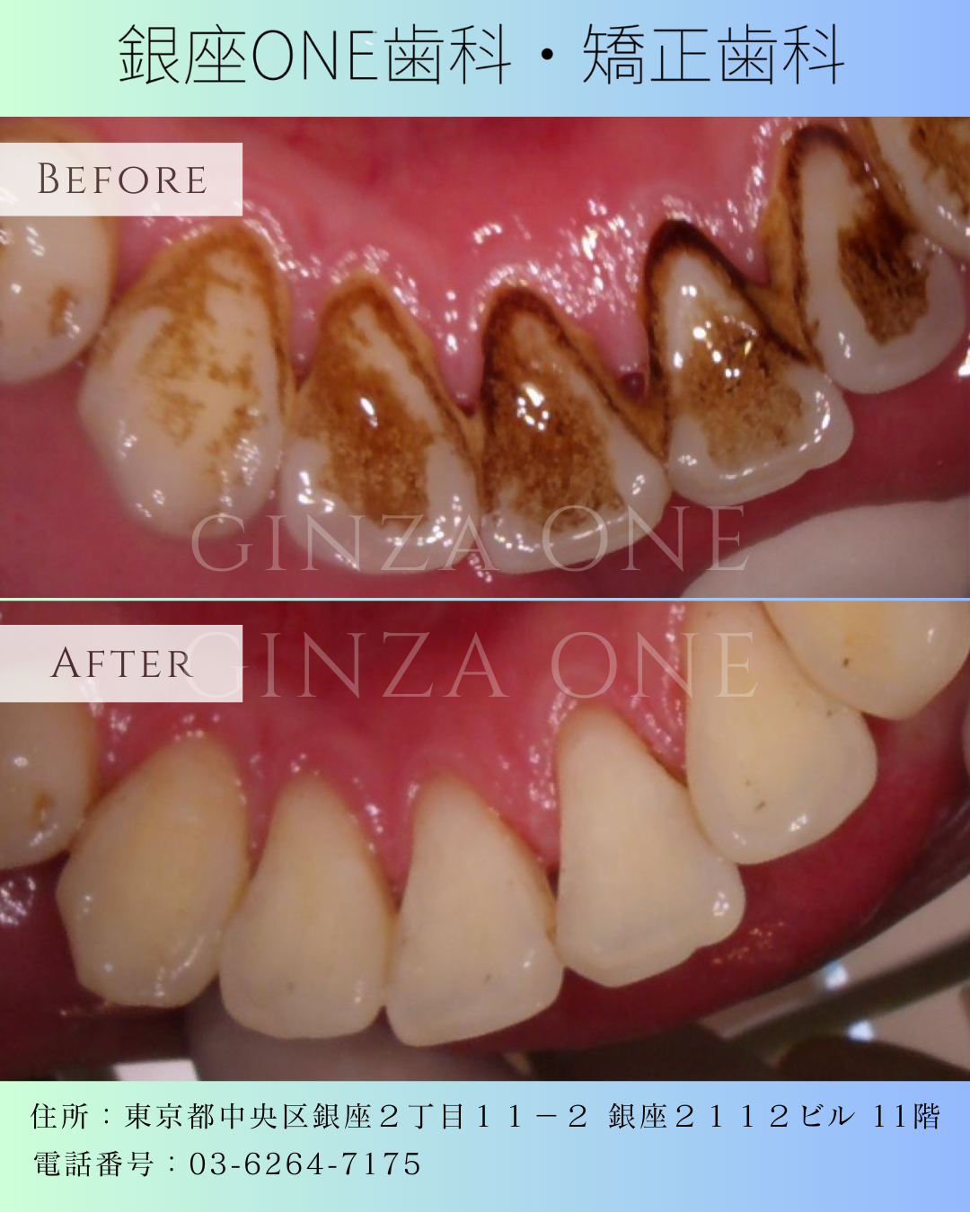 喷砂洁牙 Airflow™：为什么越来越多人选择这种新型洗牙？｜银座ONE齿科