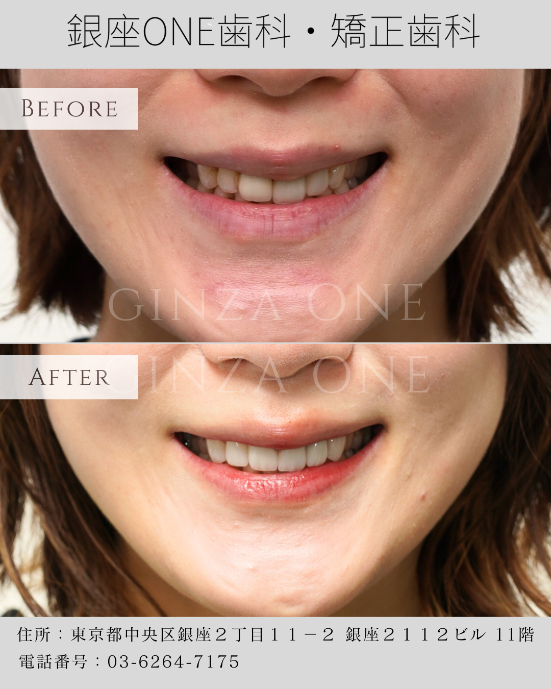 Veneers Are Not “Instagram Teeth”