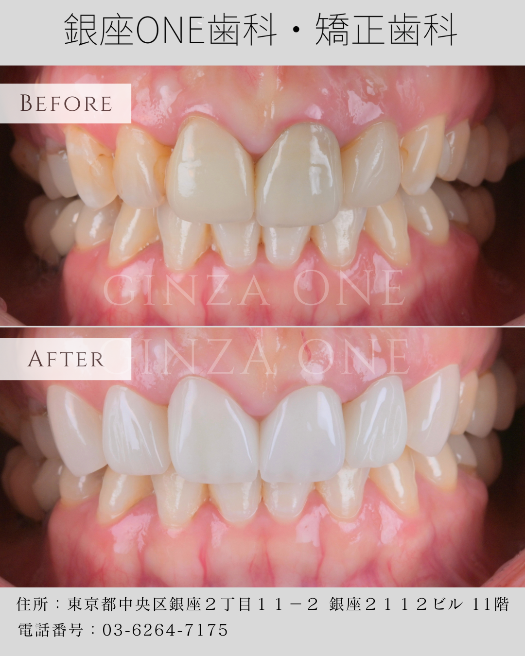 ベニア＝“インフルエンサー歯”ではない