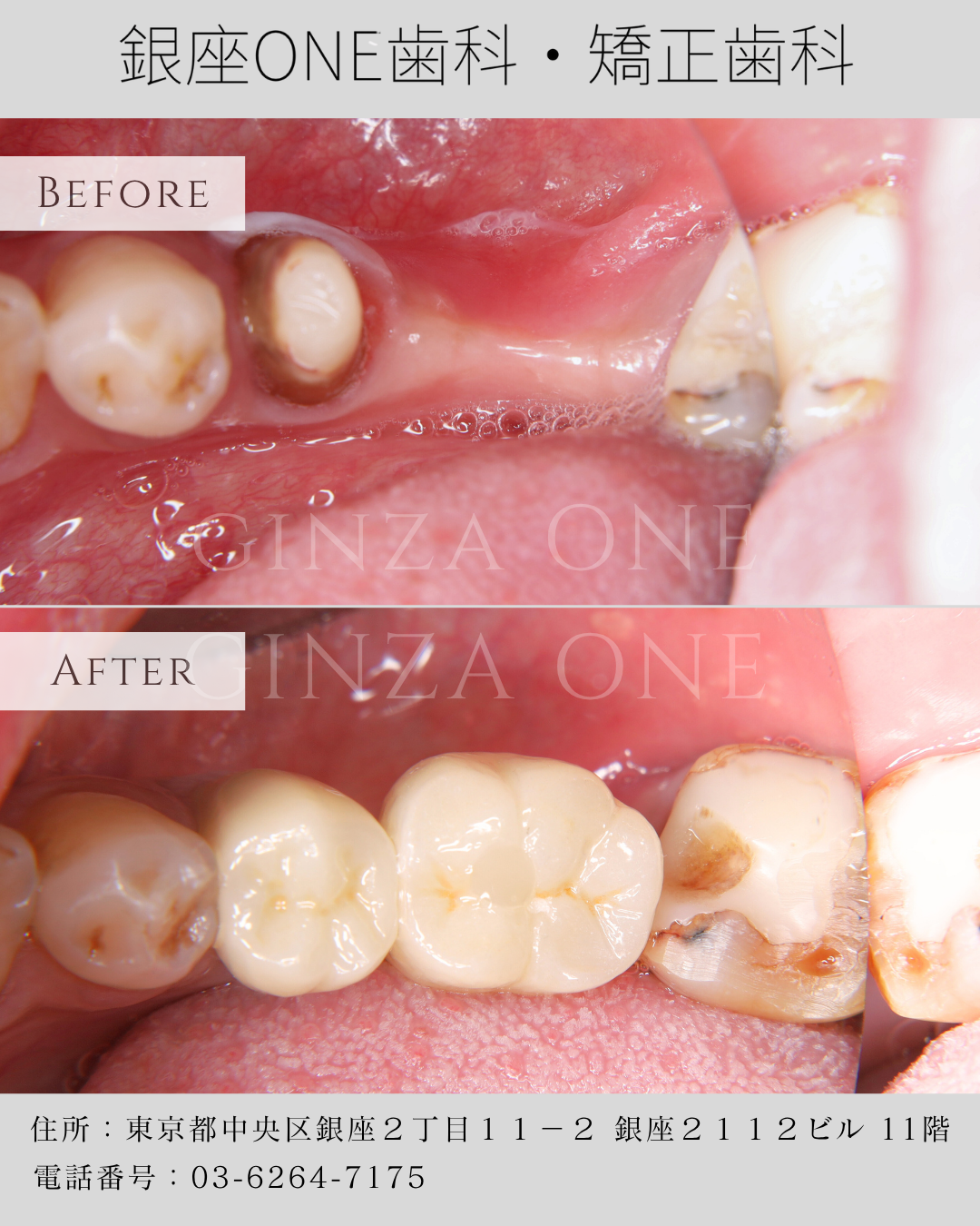 歯を失ったとき、後悔しないための治療選択とは｜銀座ONE歯科・矯正