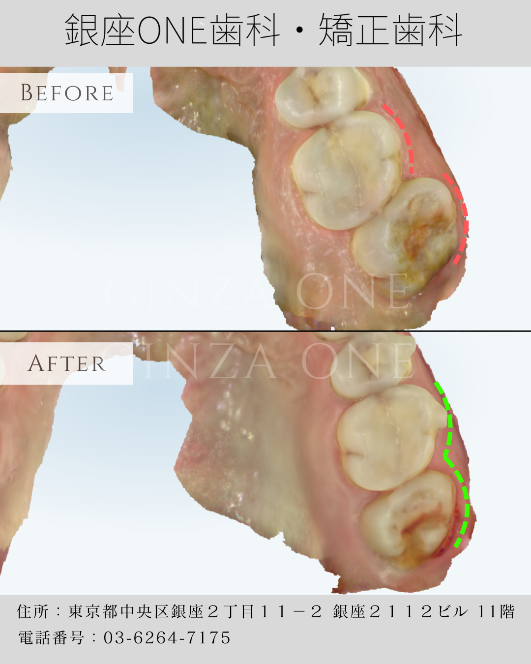 My Teeth Look Straight, But Why Is It Hard to Chew?