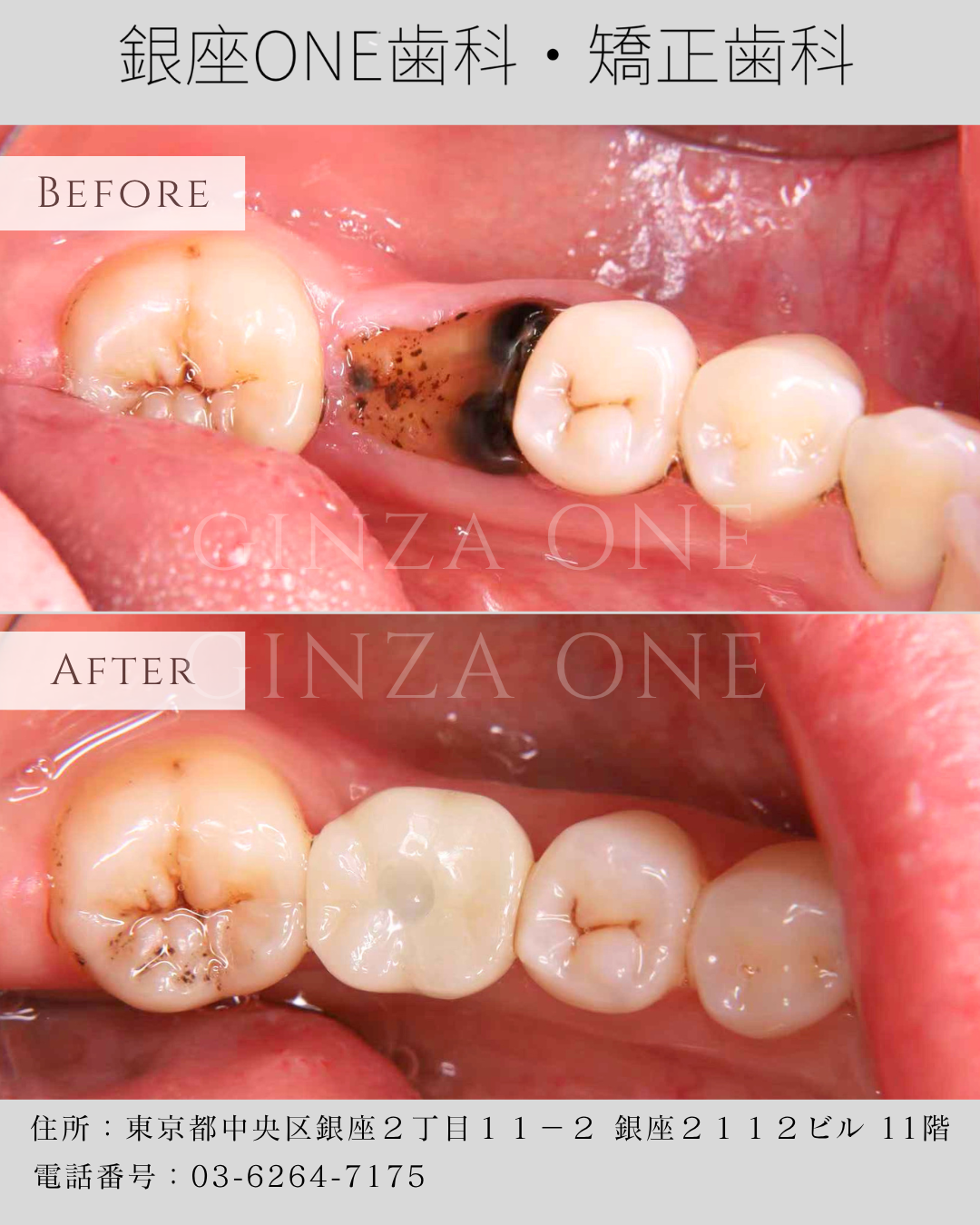 为什么有些人种植牙能用一辈子，有些人10年就出问题？