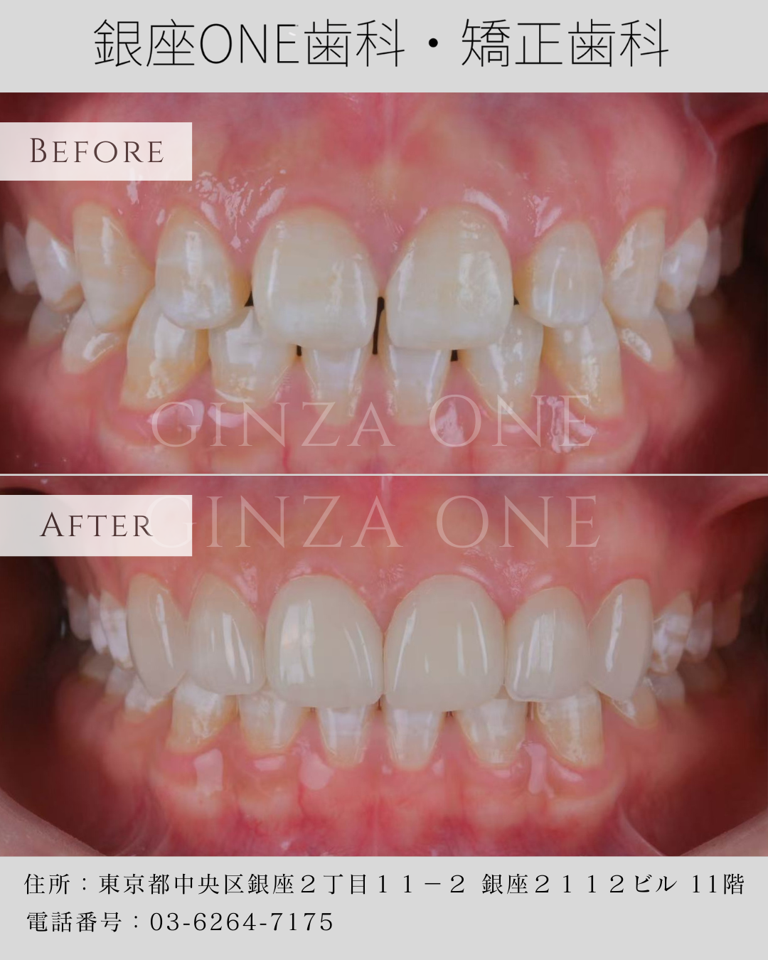 贴面 ≠「磨小牙」