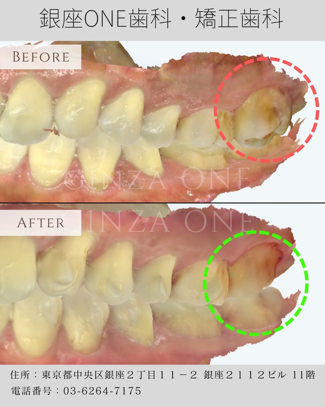 歯並びはきれいなのに、噛みにくい？