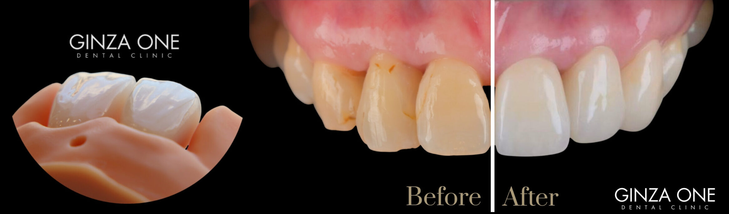 ラミネートベニアが適している3つのタイプ