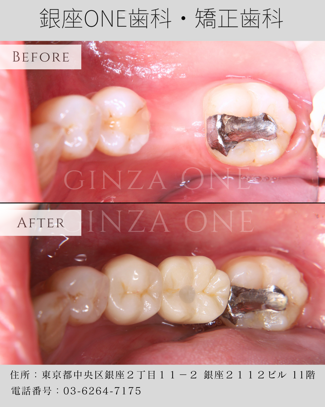 なぜインプラントが一生もつ人と、10年で問題が出る人がいるのか？